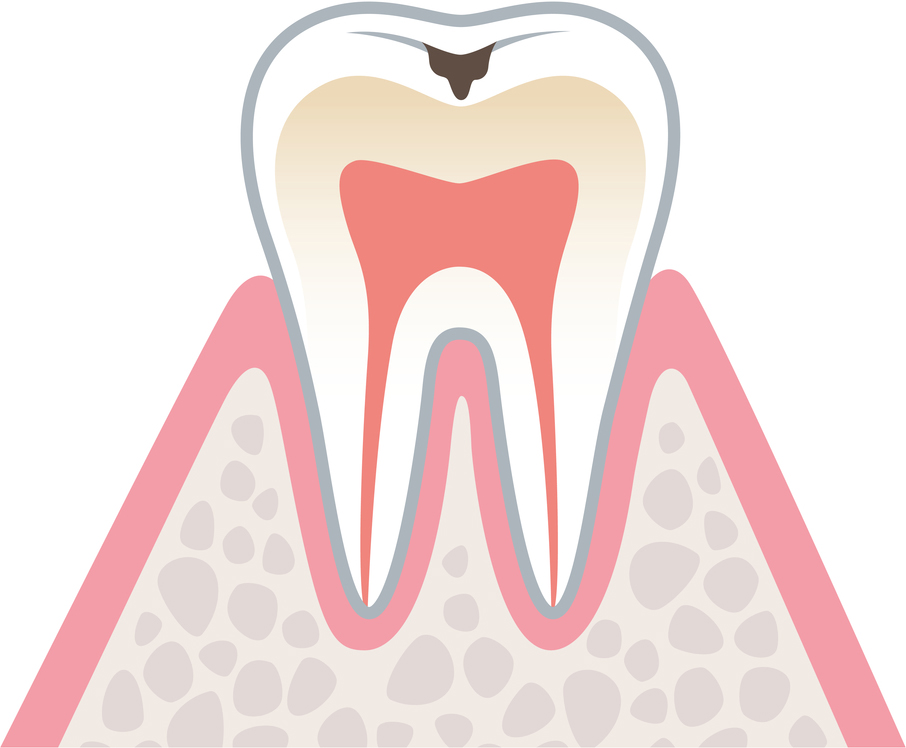 虫歯の進行　C1