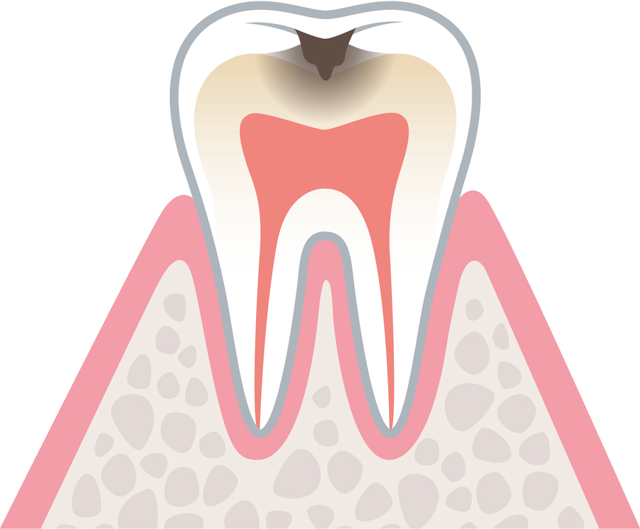 虫歯の進行　C2