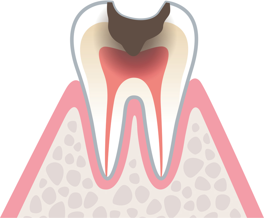 虫歯の進行　C3