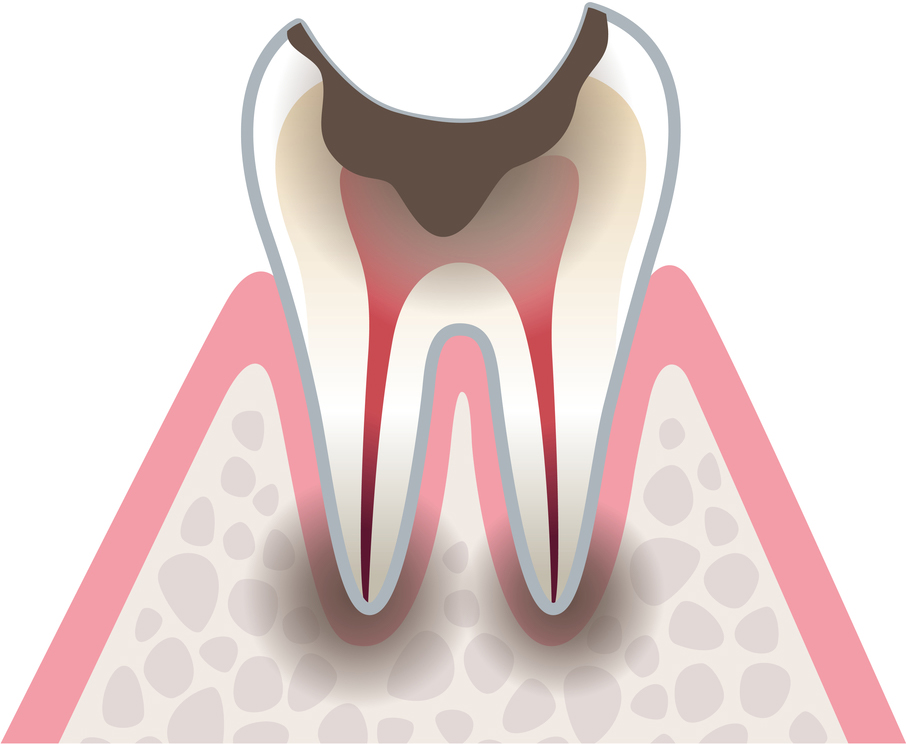虫歯の進行　C4