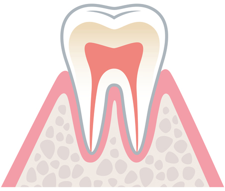 歯周病の進行（初期）