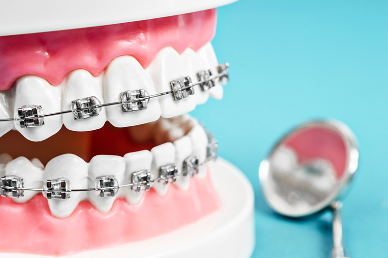歯の矯正装置